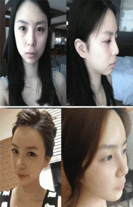 52 plastic surgery photos in korea that prove miracles exist medium
