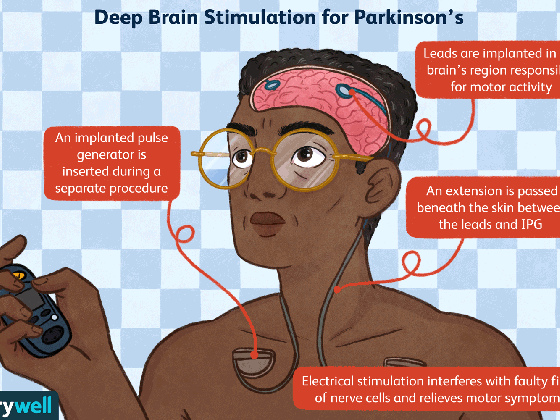 deep brain stimulation for parkinson s benefits and risks passed out gif medium