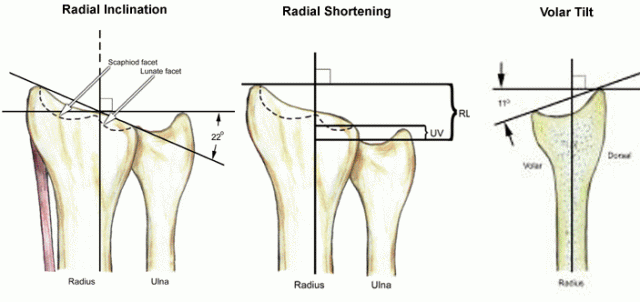 distal radius fractures trauma orthobullets medium