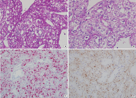 sclerosing perivascular epithelioid cell tumor of the lung a case small