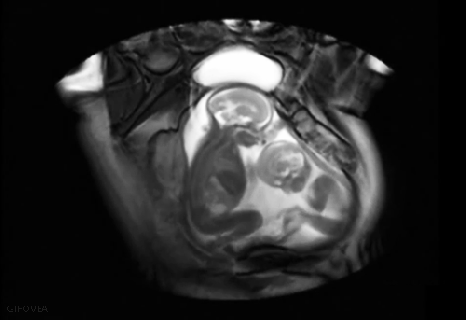 https://cdn.lowgif.com/small/bc04b9aec897ebd4-twins-interaction-uterus-with-mri-medical-gif.gif